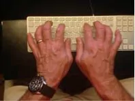 Incorrect typing: Duck-footed, outward facing wrists