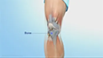 Subchondroplasty