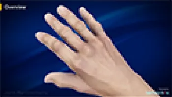Joint Synovectomy