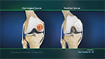 Osteochondral Allograft