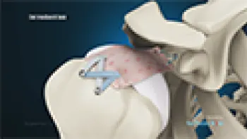 Superior Capsule Reconstruction