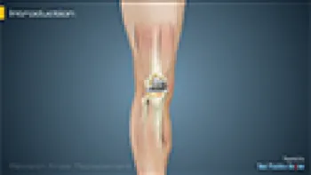 Revision Knee Replacement (Joint Replacement)