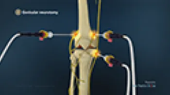 Genicular Neurotomy (Knee)