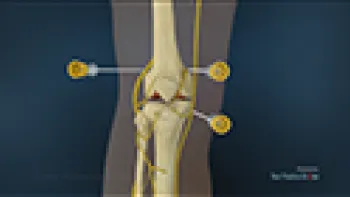 Coolief Procedure for Arthritis Pain