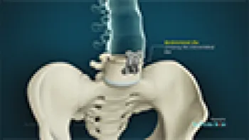 Anterior Lumbar Interbody Fusion