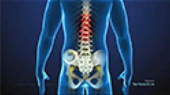 Spinal Cord Stimulator Implant (Pain Management)
