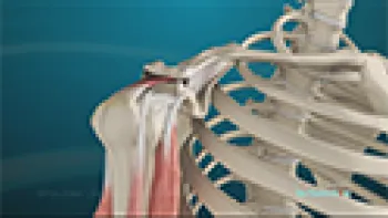 Shoulder Joint Replacement (Joint Replacement)