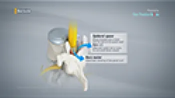 Epidural Injection (Spine)