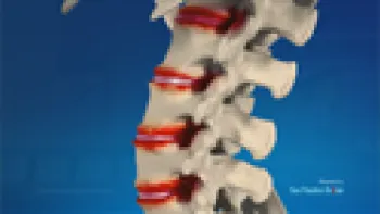 Spondyloarthritis