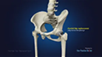 Partial Hip Replacement