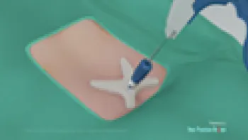 The mild® Procedure for Spinal Stenosis