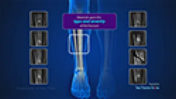 Fractures of the Tibia