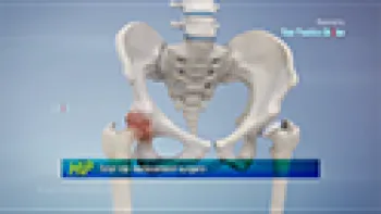 Total Hip Replacement (Hip)