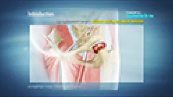 Anterior Hip Replacement (Joint Replacement)