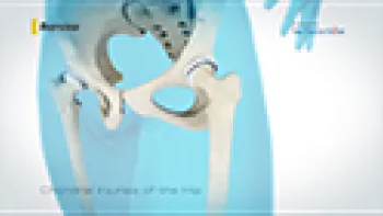 Chondral Injuries of Hip