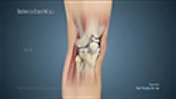 Minimally Invasive Knee Joint Replacement (Joint Replacement)