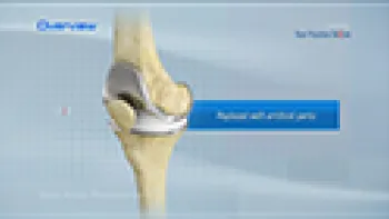 Total Knee Replacement (Knee)