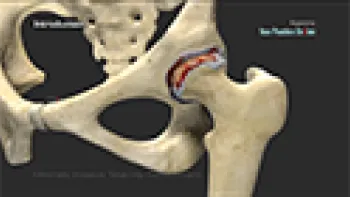 Minimally Invasive Total Hip Replacement (Joint Replacement)