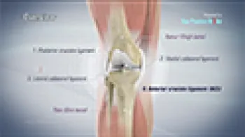 ACL Reconstruction Hamstring Method