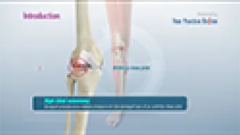 High Tibial Osteotomy (Knee)