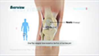Patellofemoral Pain Syndrome (Knee)