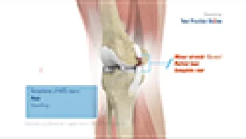 Medial Collateral Ligament Reconstruction