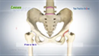 Labral Tears of the Hip
