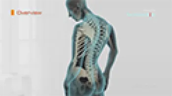 Spondylosis