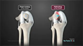 Tibial Tubercle Osteotomy