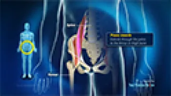 Psoas Tendonitis