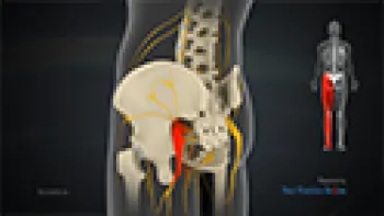 Sciatica