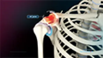Distal Clavicle Excision