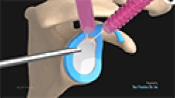 SLAP Repair