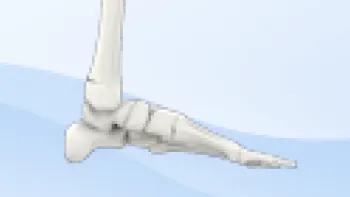 Ankle Fracture