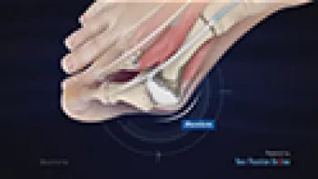 Bunions