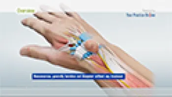 Ganglion Cyst Removal