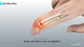 Mallet Finger