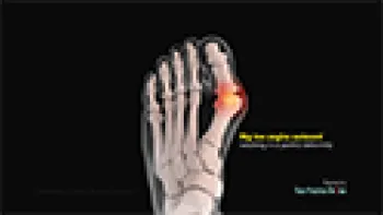 Minimally Invasive Bunion Surgery