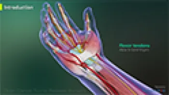 Open Carpal Tunnel Release Surgery