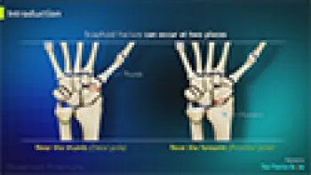 Scaphoid Fracture