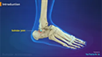 Subtalar Arthroscopy