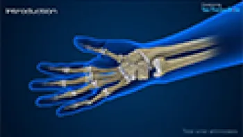Total Wrist Arthrodesis