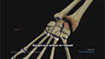 Wrist Joint Replacement