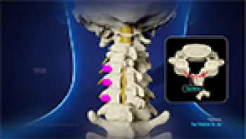 Photo: Cervical Laminoplasty