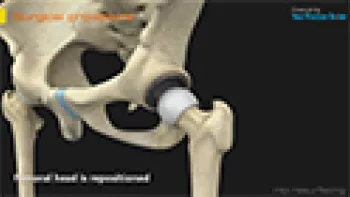 Hip Resurfacing