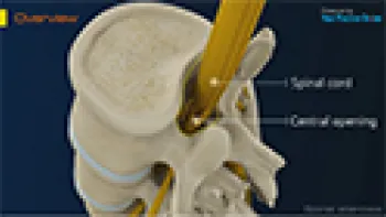 Spinal Stenosis