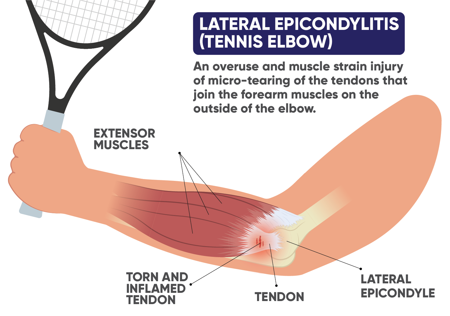 Lateral epicondylitis