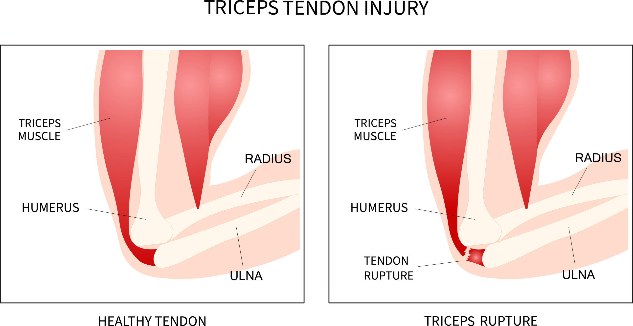 Ruptured Biceps or Triceps Tendon - Golden State Orthopedics & Spine