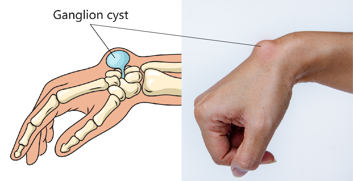 Ganglion and Mucous Cysts - Golden State Orthopedics & Spine
