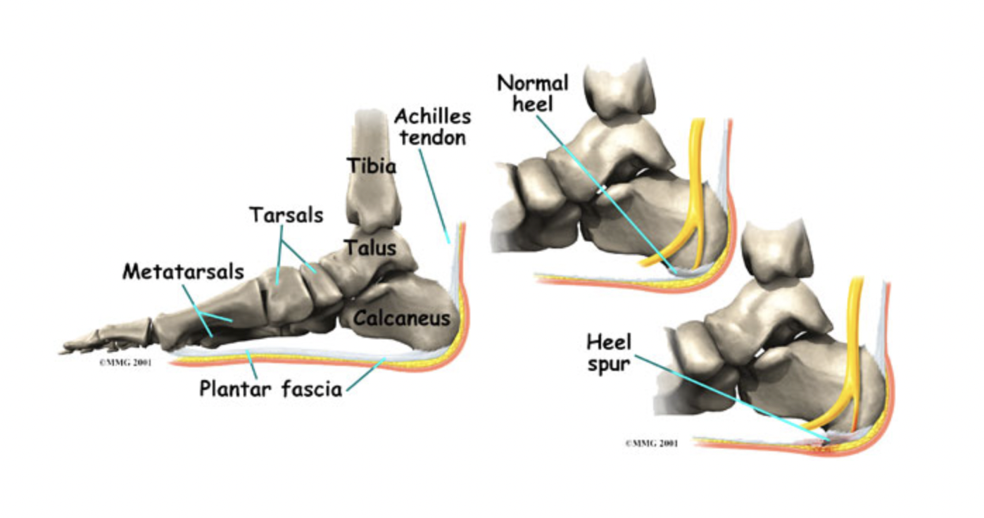 Plantar Fasciitis - Golden State Orthopedics & Spine